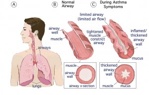 Asthma attack illustration