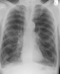 COPD Chest Xray